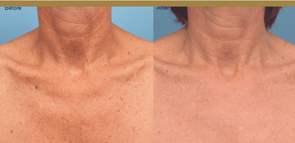 Reasons To Incorporate Intense Pulsed Light Therapy (IPL) Into Your Regimen 649b538e38e9e.png