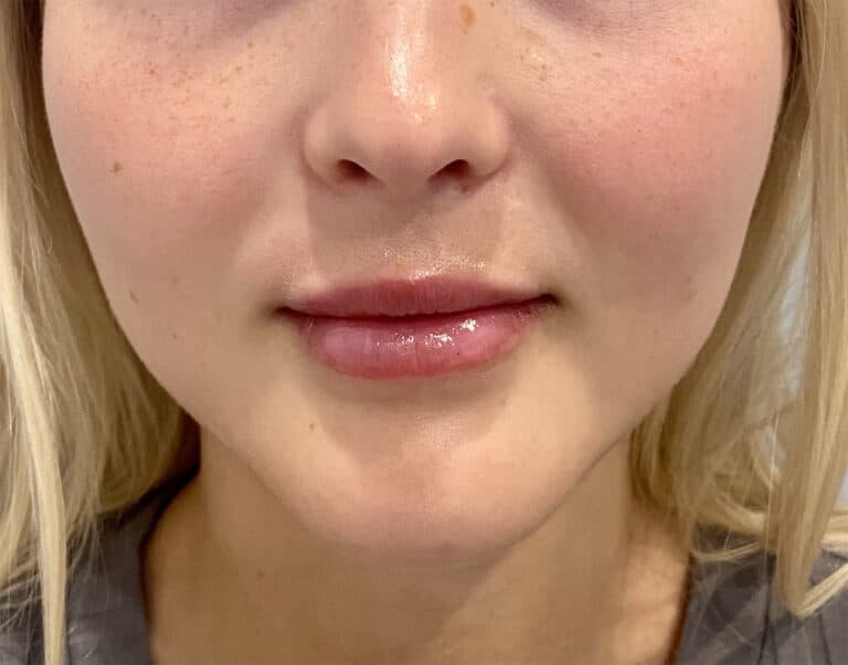After Image: Juvederm Volbella - front