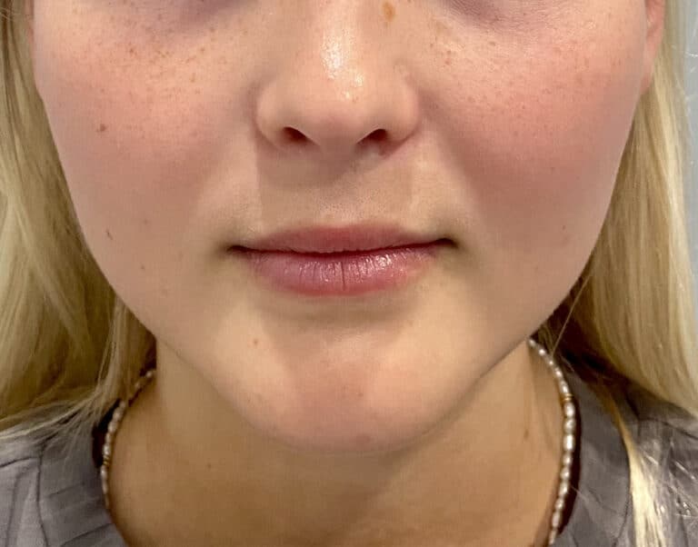 Before Image: Juvederm Volbella - front