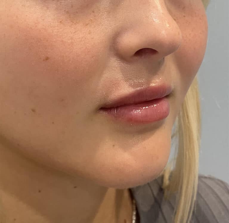 After Image: Juvederm Volbella - right-front-oblique