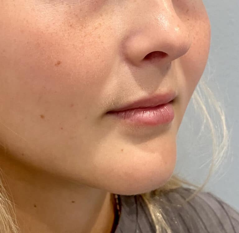 Before Image: Juvederm Volbella - right-front-oblique