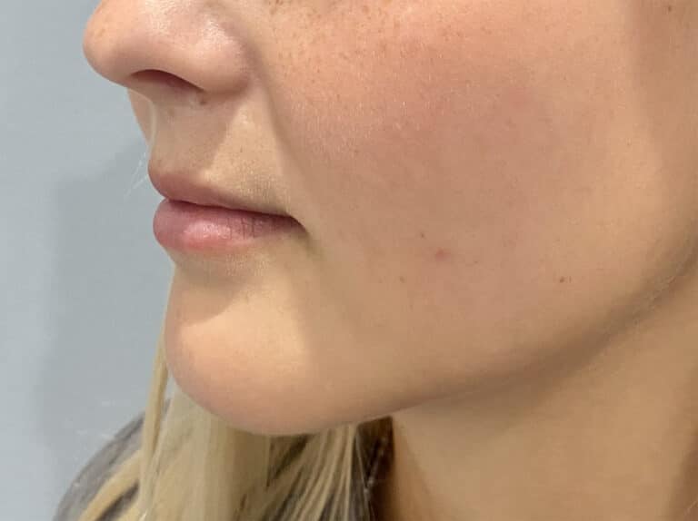 Before Image: Juvederm Volbella - left-front-oblique