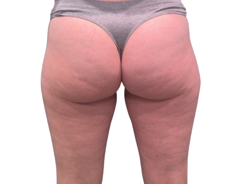 Before Image: Morpheus Butt & Thighs - back