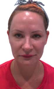 After Image: Juvederm Filler