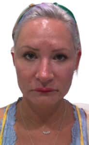 Before Image: Juvederm Filler