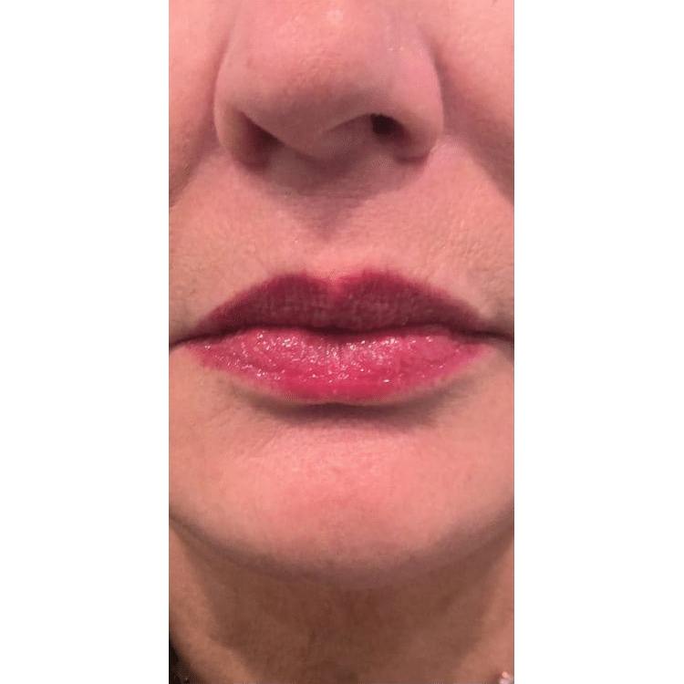 After Image: Botox - front