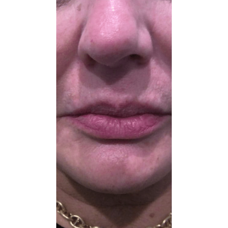 Before Image: Botox - front