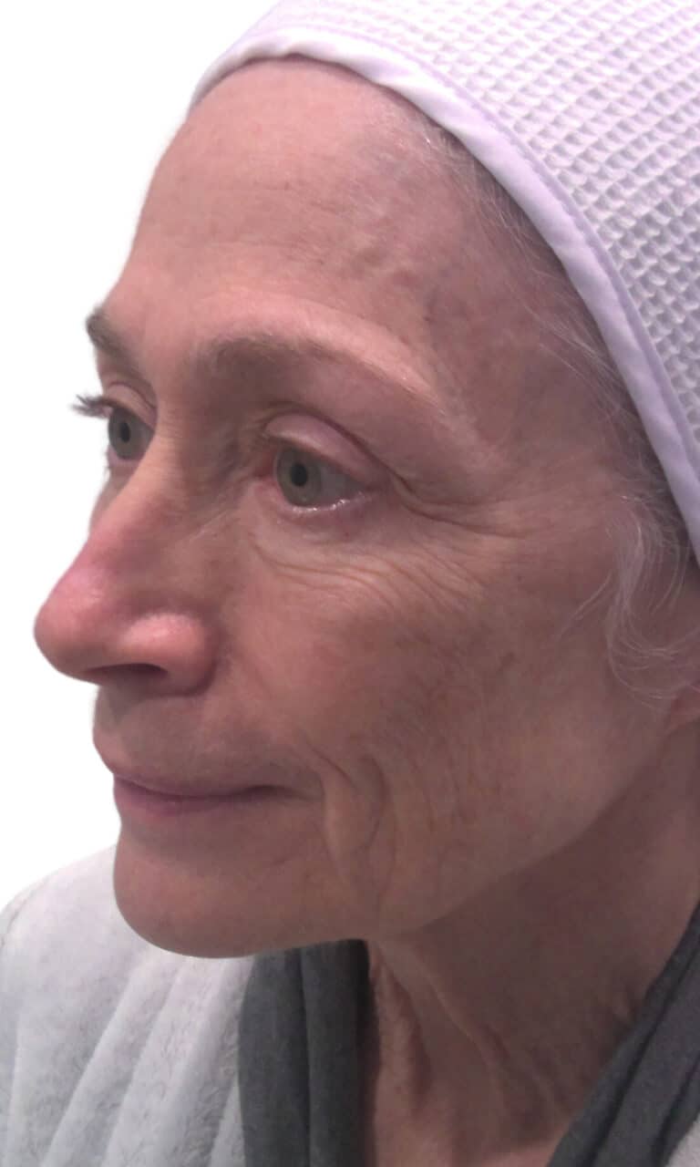 Before Image: Microneedling with PRF - left-front-oblique