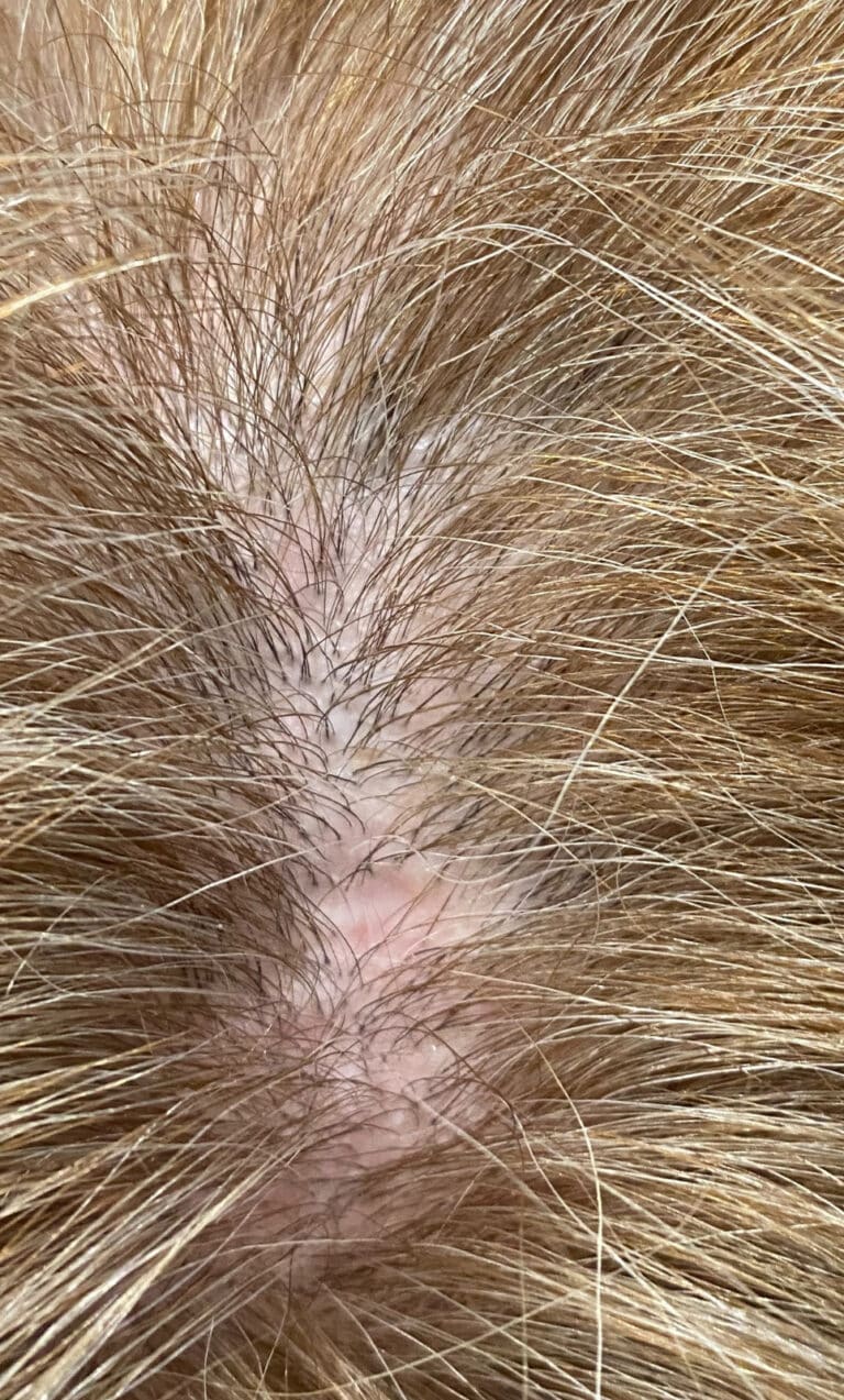 After Image: PRF Hair Restoration - front