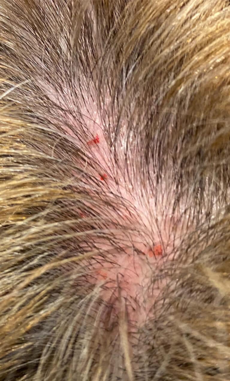 Before Image: PRF Hair Restoration - front