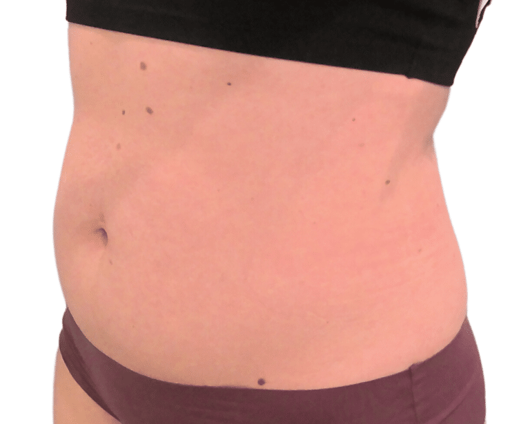 After Image: Emsculpt - left-front-oblique