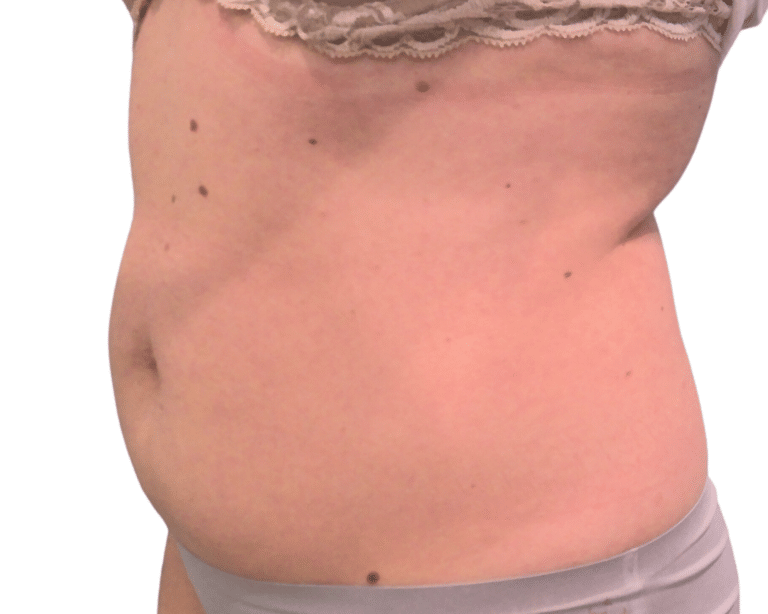 Before Image: Emsculpt - left-front-oblique