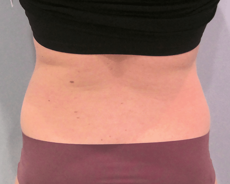 After Image: Emsculpt - back