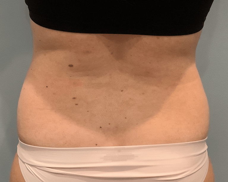 Before Image: Emsculpt - back