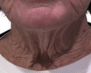 Before Image: Morpheus Neck
