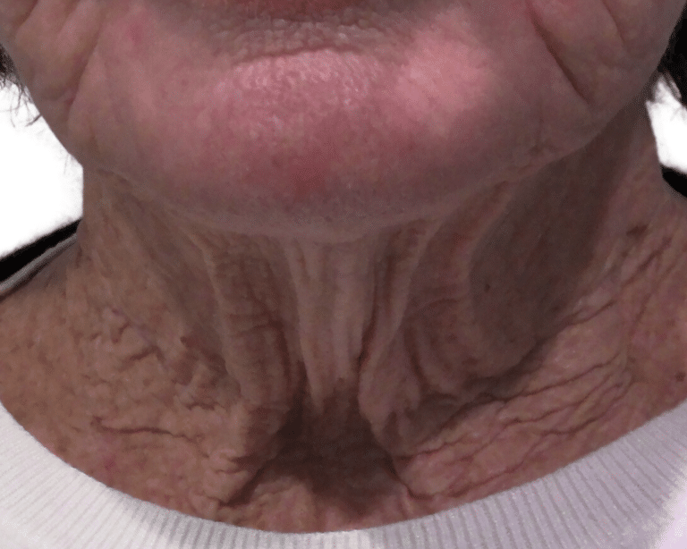 Before Image: Morpheus Neck - front