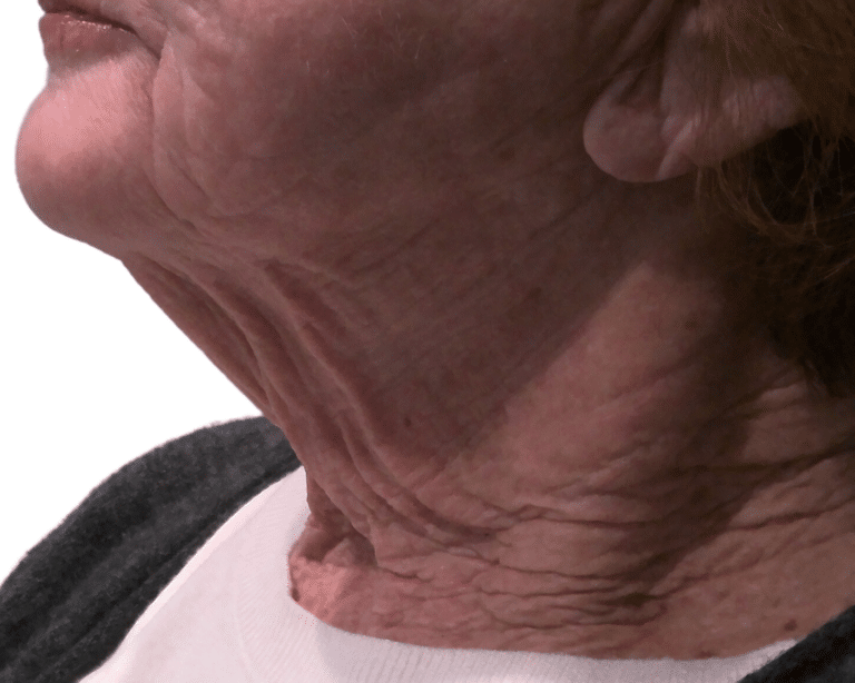 Before Image: Morpheus Neck - left-side