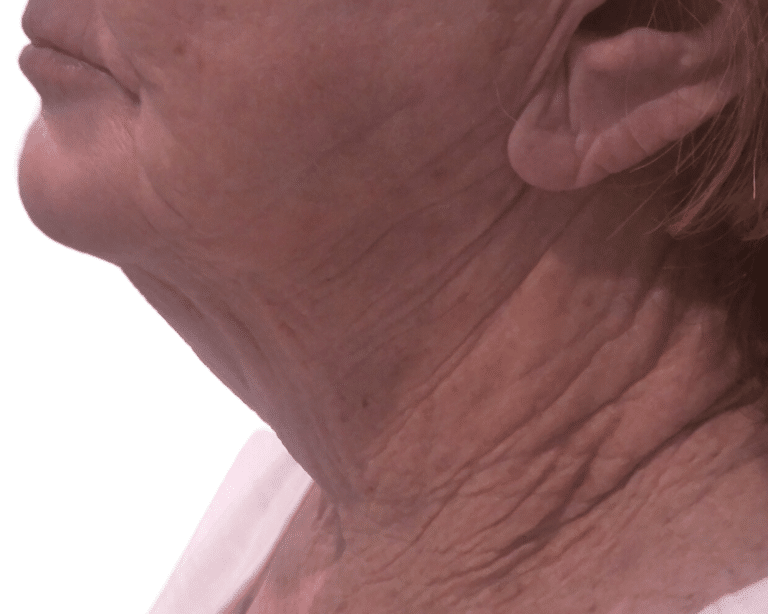 After Image: Morpheus Neck - left-side