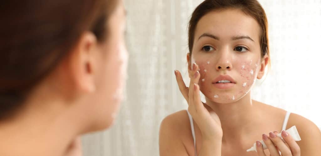 Acne 64c40f0c3d443.jpeg
