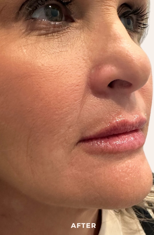 After Image: Lip Enchancement - right-front-oblique
