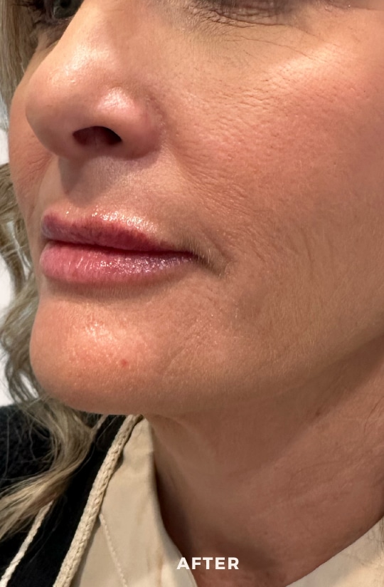 After Image: Lip Enchancement - left-front-oblique