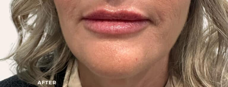 After Image: Lip Enchancement - front