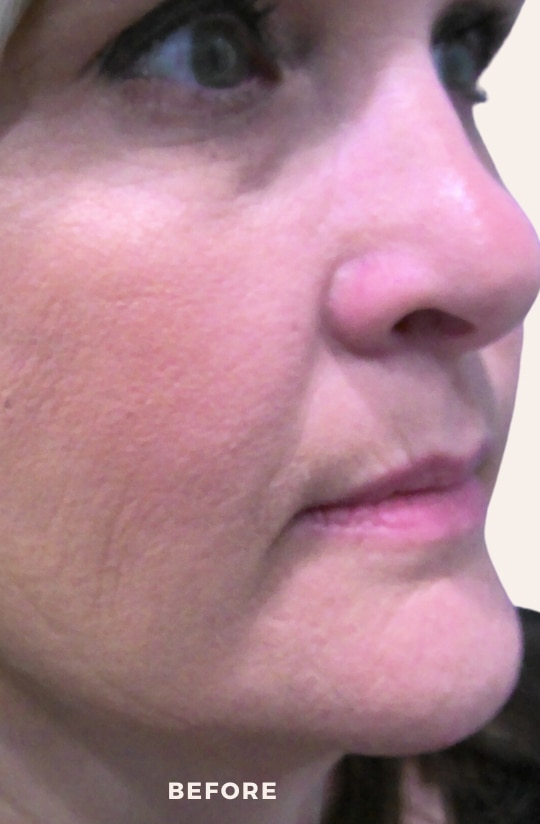 Before Image: Lip Enchancement - right-front-oblique