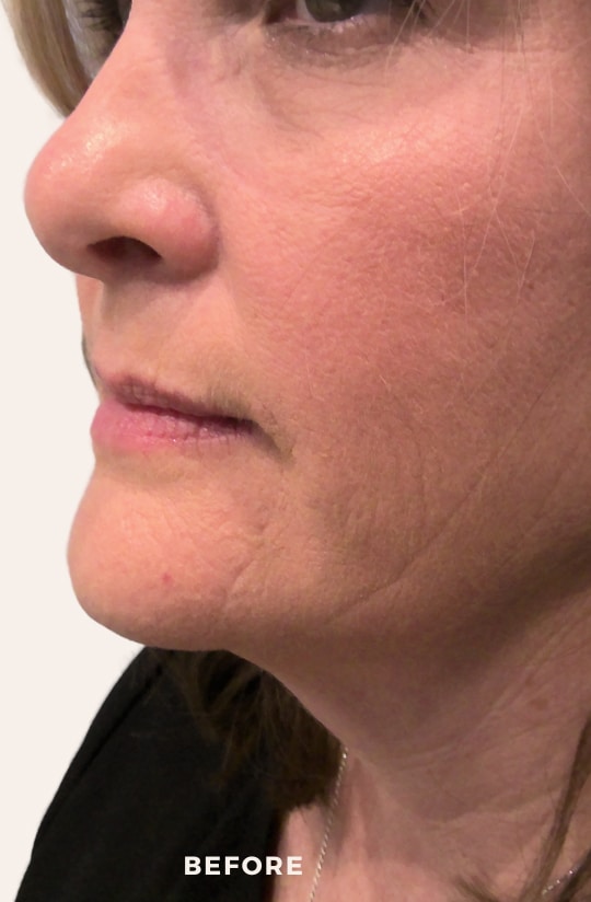 Before Image: Lip Enchancement - left-front-oblique