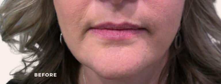 Before Image: Lip Enchancement - front