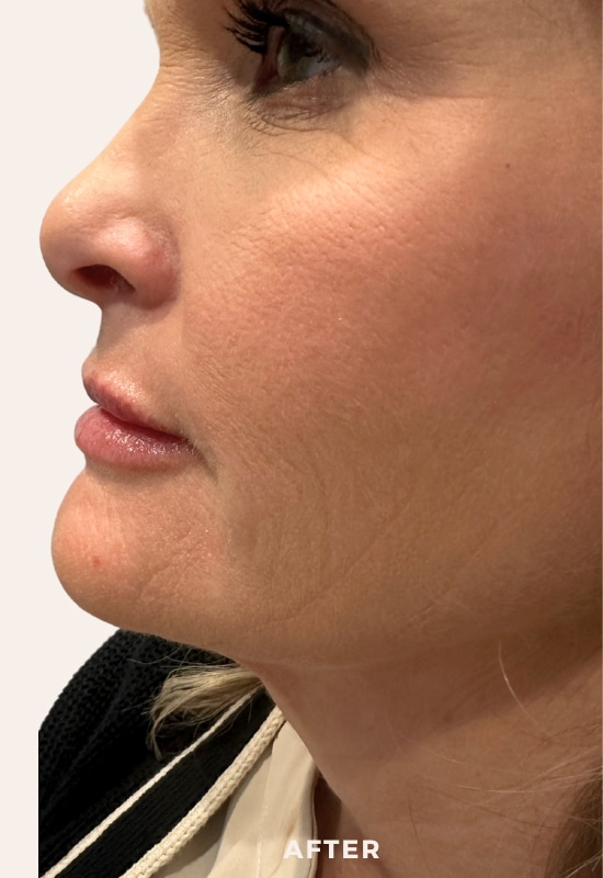 After Image: Facial Balancing - left-side