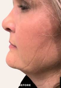 Before Image: Facial Balancing