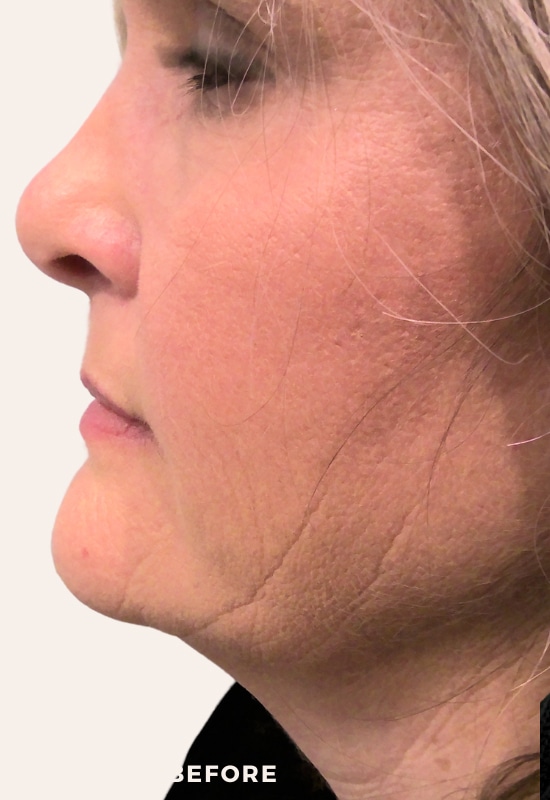 Before Image: Facial Balancing - left-side