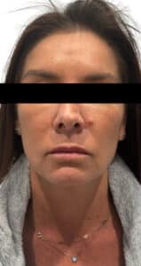 After Image: Facial Balancing