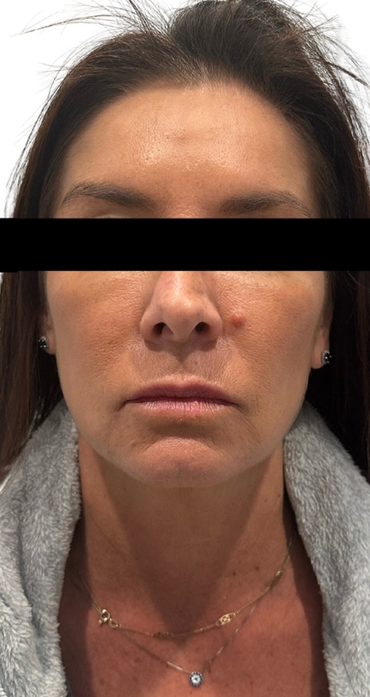 After Image: Facial Balancing - front
