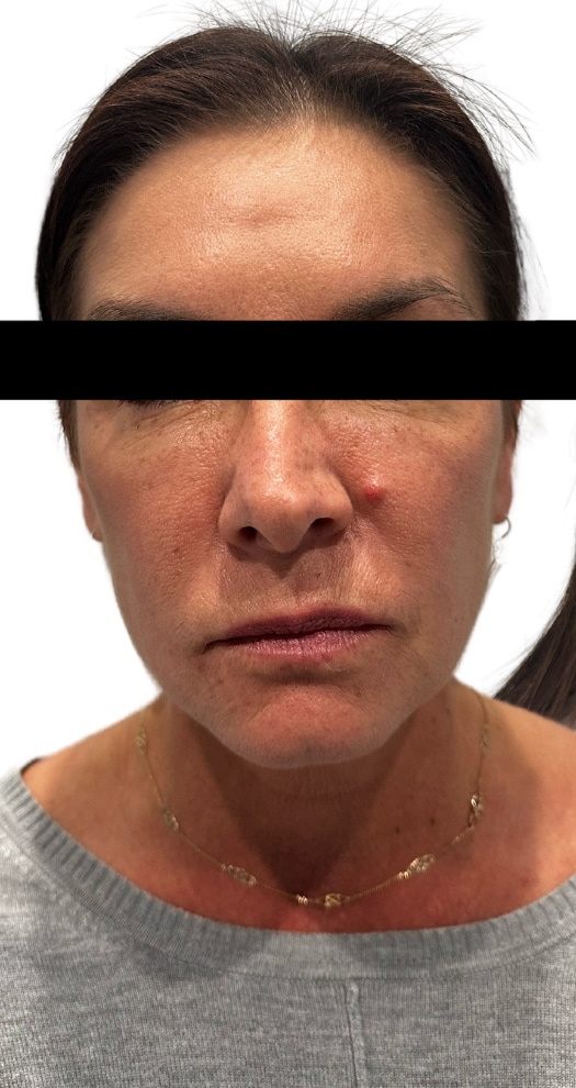 Before Image: Facial Balancing - front