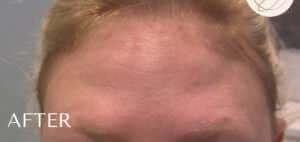 After Image: Botox