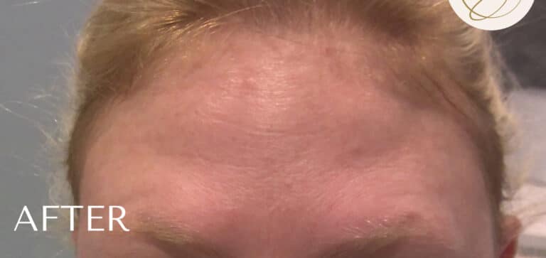 After Image: Botox - front