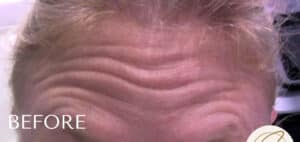Before Image: Botox