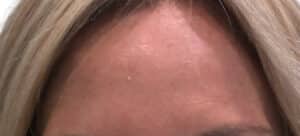 After Image: Botox