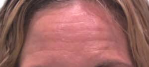 Before Image: Botox