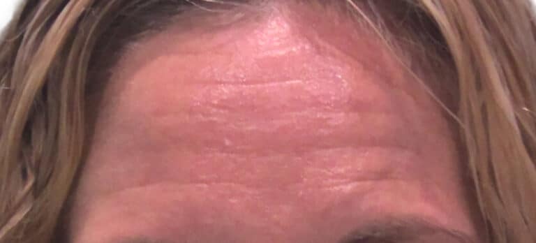 Before Image: Botox - front