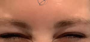 After Image: Botox