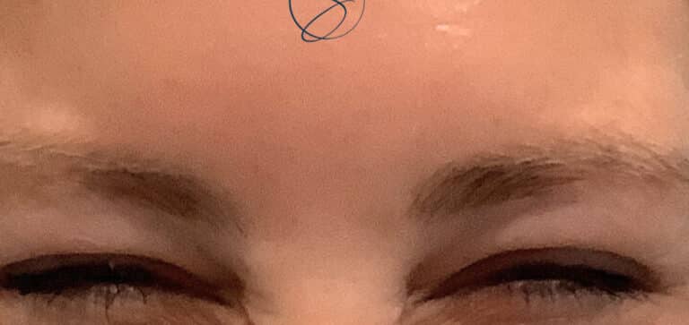 After Image: Botox - front
