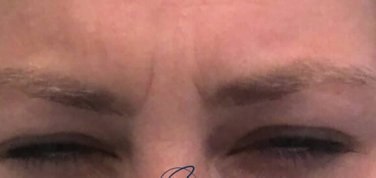 Before Image: Botox - front