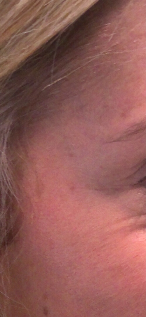 After Image: Botox - right-front-oblique