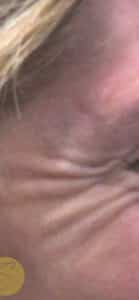 Before Image: Botox