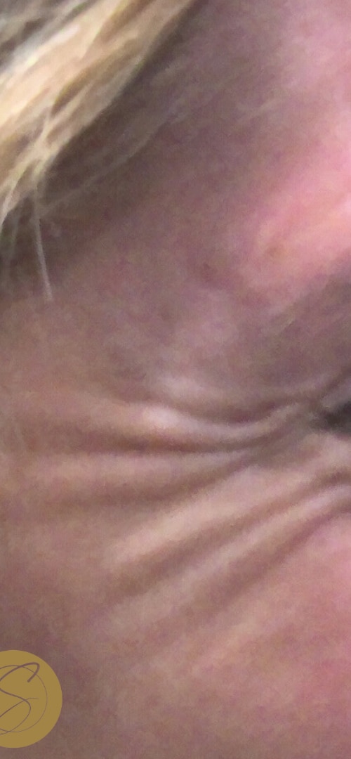 Before Image: Botox - right-front-oblique