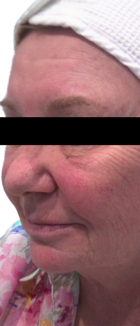 Before Image: BroadBand Light - left-front-oblique
