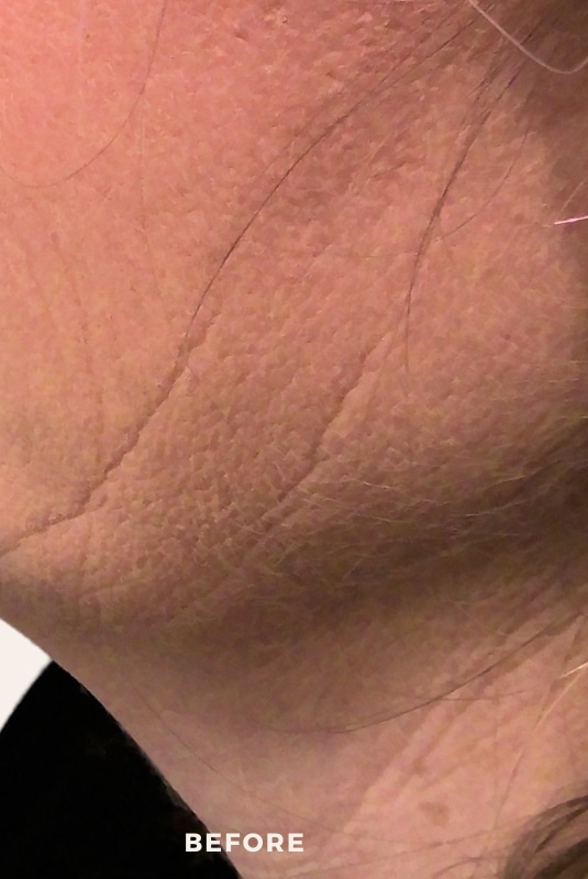 Before Image: Morpheus8 - left-side
