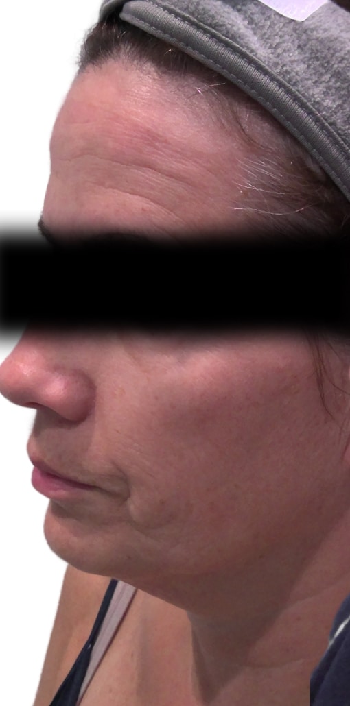 Before Image: Morpheus8 - left-side